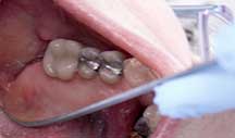 tooth